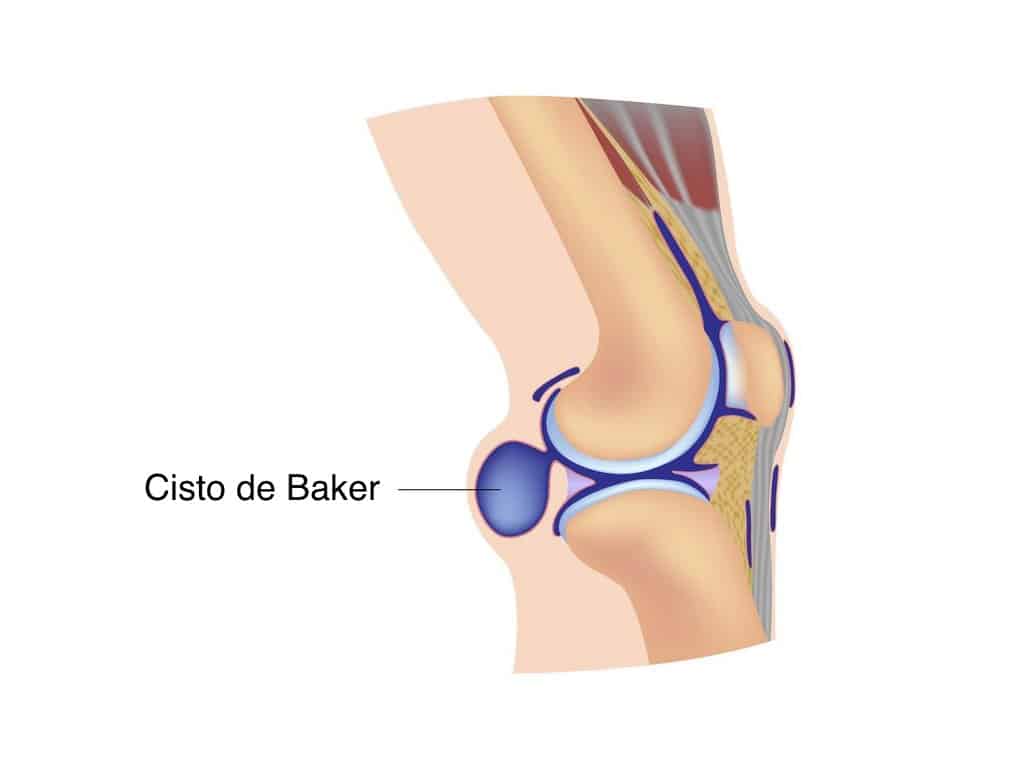 Cisto de Baker – Dr. Guilherme de Barros Baruki