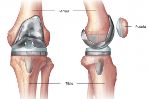 Artroplastia-980x735